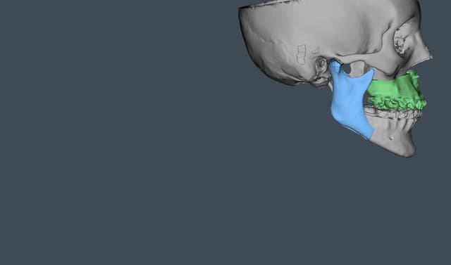 Oral Maxillofacial Surgeon Increases Accuracy, Reduces Operating Time Using  VSP Orthognathics | 3D Systems