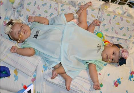 3D Systems Delivering a new life to Hernandez-Torres conjoined twins with VSP and 3D printed models