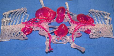 3D Systems Delivering a new life to Hernandez-Torres conjoined twins with VSP and 3D printed models