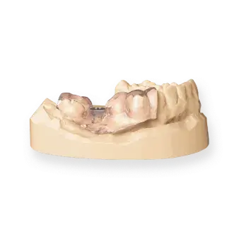 NextDent SG (Surgical Guide) | 3D Systems