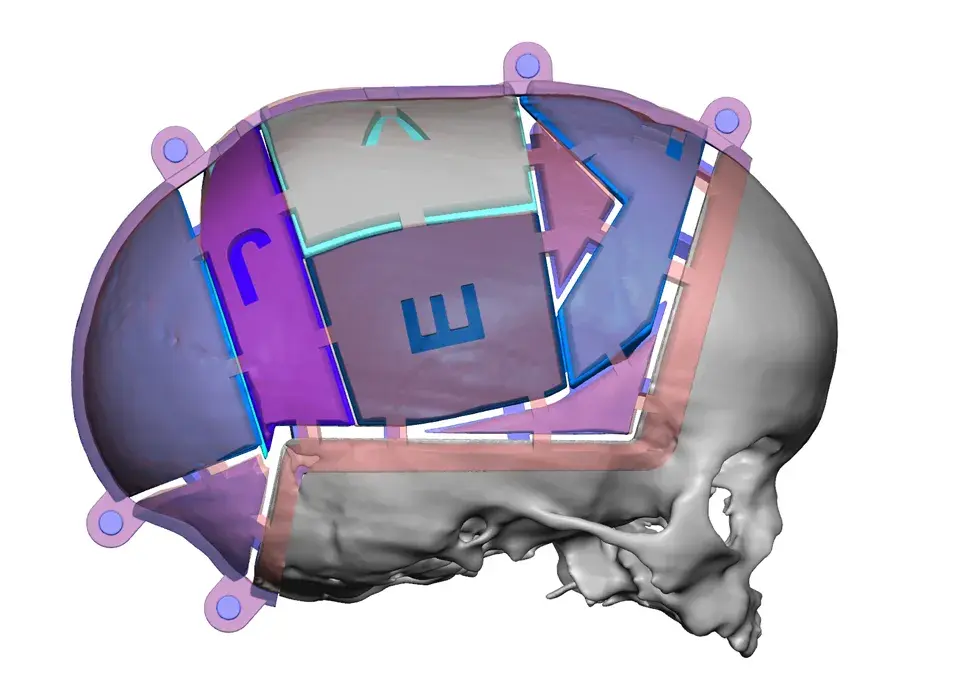 VSP Cranial Pre-Op Resected with Guides