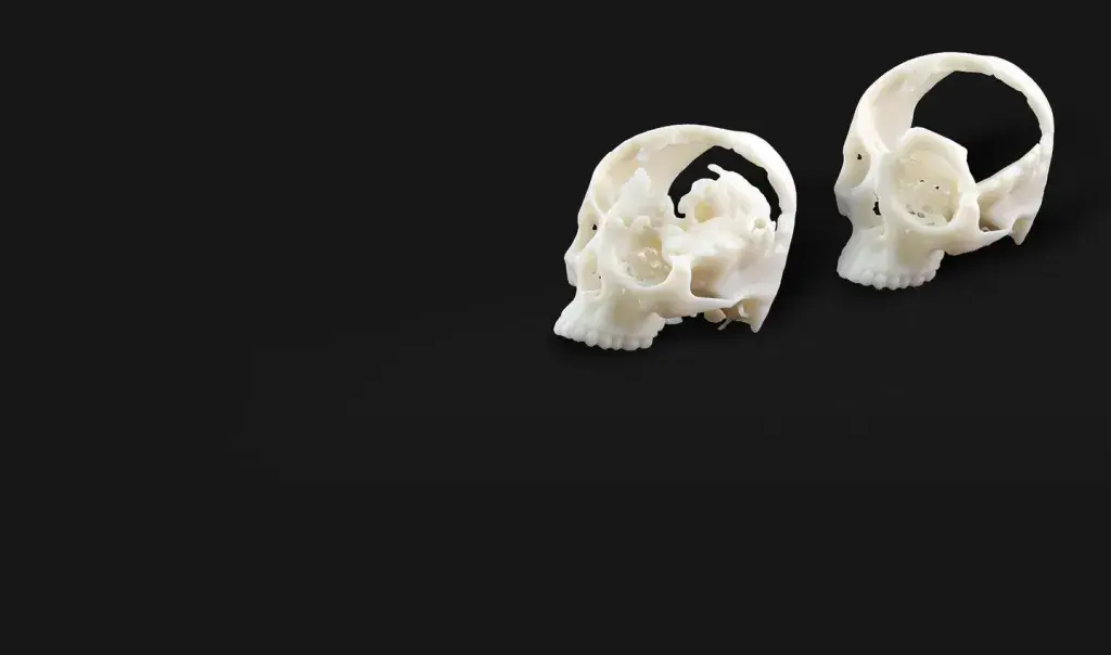 Customer Story Surgeries aided by 3D medical technologies deliver hope and a new life for Rwandan teen top banner