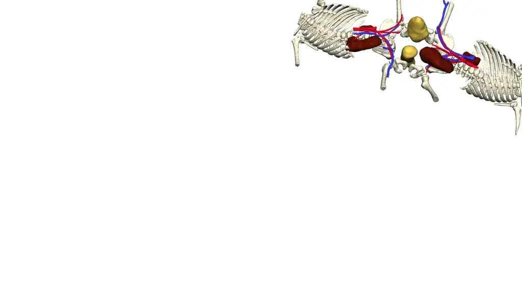 3D Systems Delivering a new life to Hernandez-Torres conjoined twins with VSP and 3D printed models