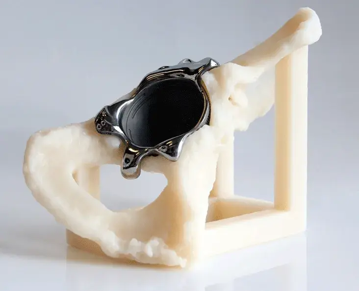 3D Systems Healthcare SLA bone model with DMP titanium triflange