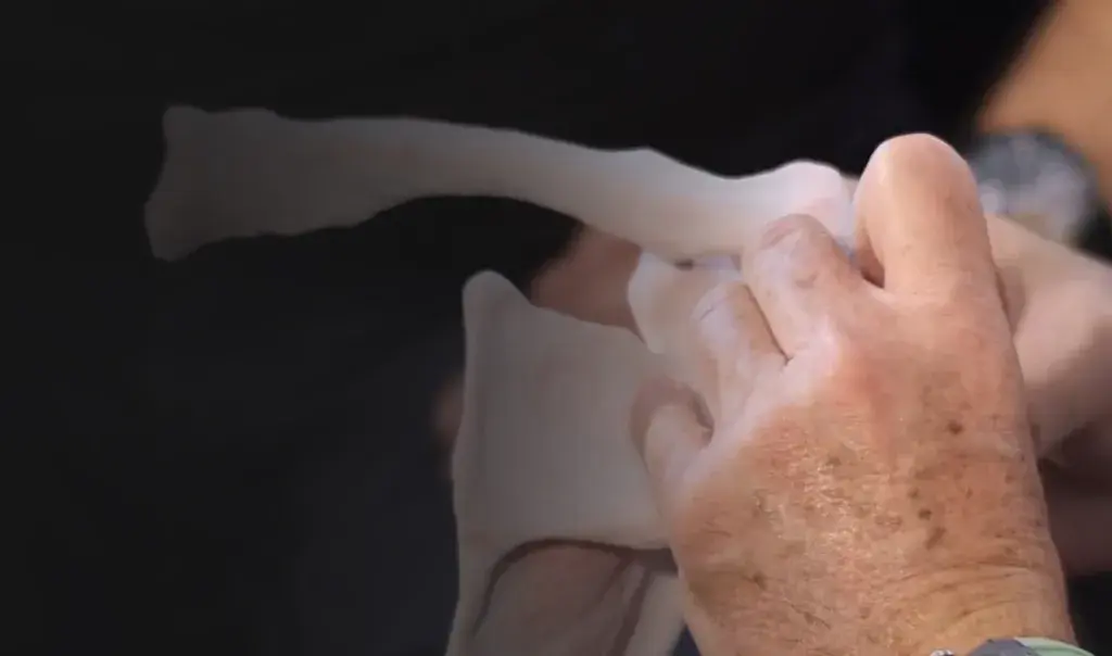 Patient Specific Printed Orthopedic Models: Game Changer in Procedure Planning and Patient Understanding