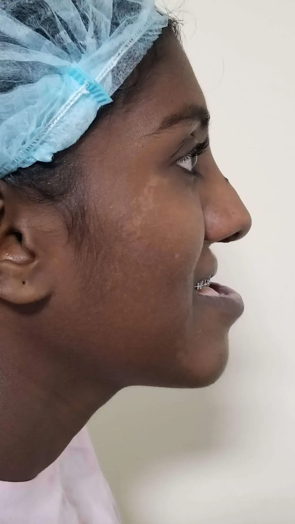 Patient occlusion pre-surgery