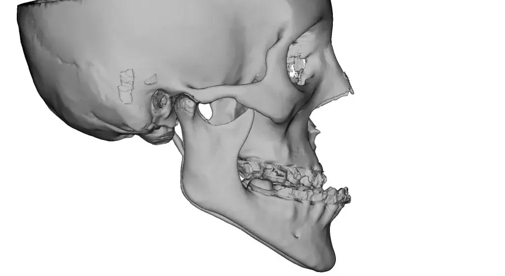 Pre-surgical planning image for VSP Orthognathics