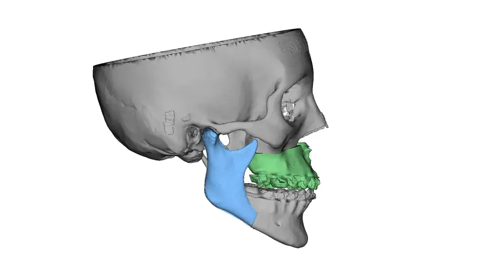 VSP Orthognathics final positioning splint