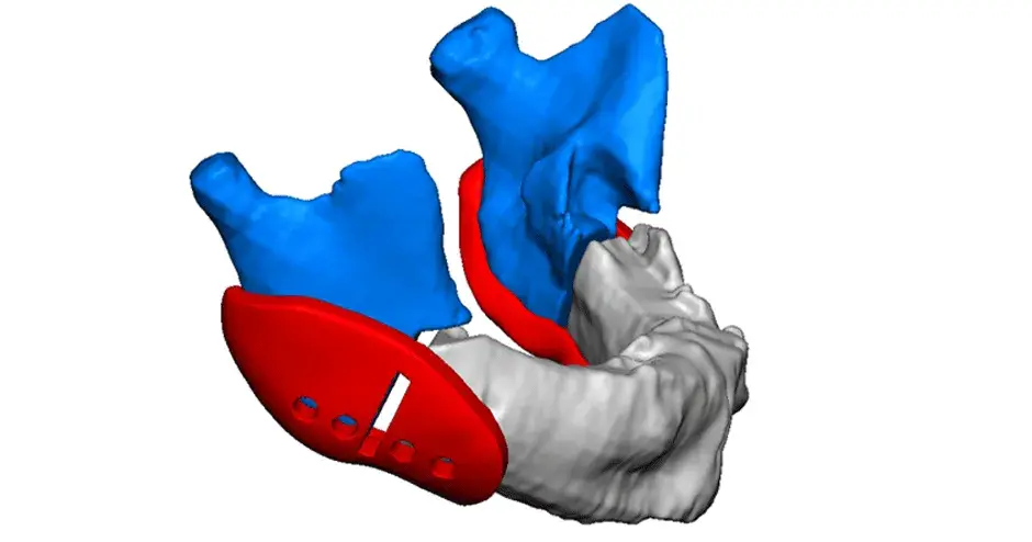 3D Systems VSP Distraction Planning Image - Guides