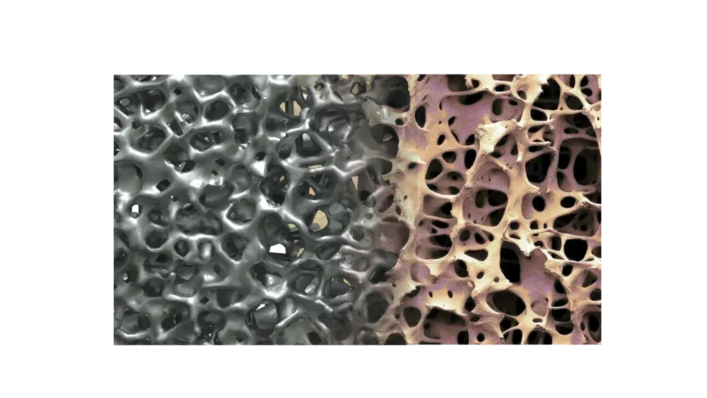 The design of NuVasive's Modulus line of spinal implants is designed to improve clinical outcomes for spinal implant patients.