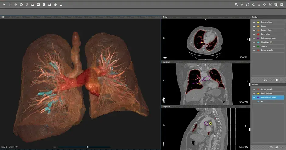 D2P Image-Lungs