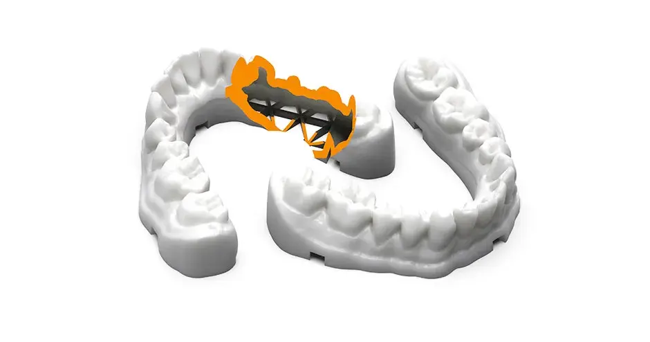 Dental bars printed from TruShell material using 3D Sprint software