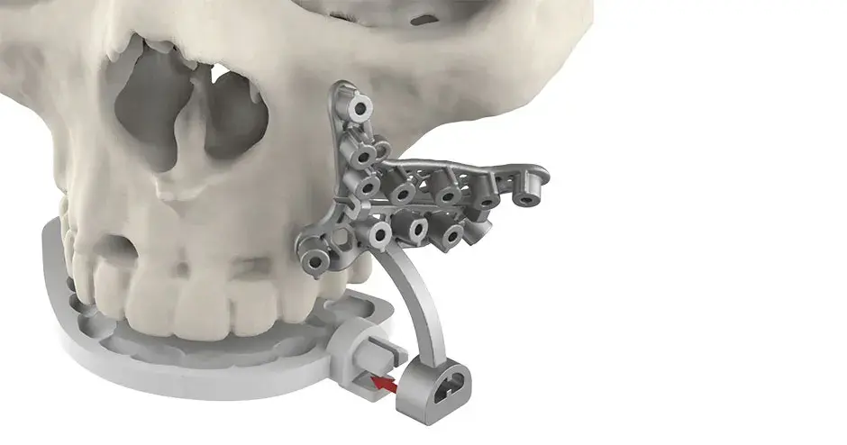 LeFort - Exploded View