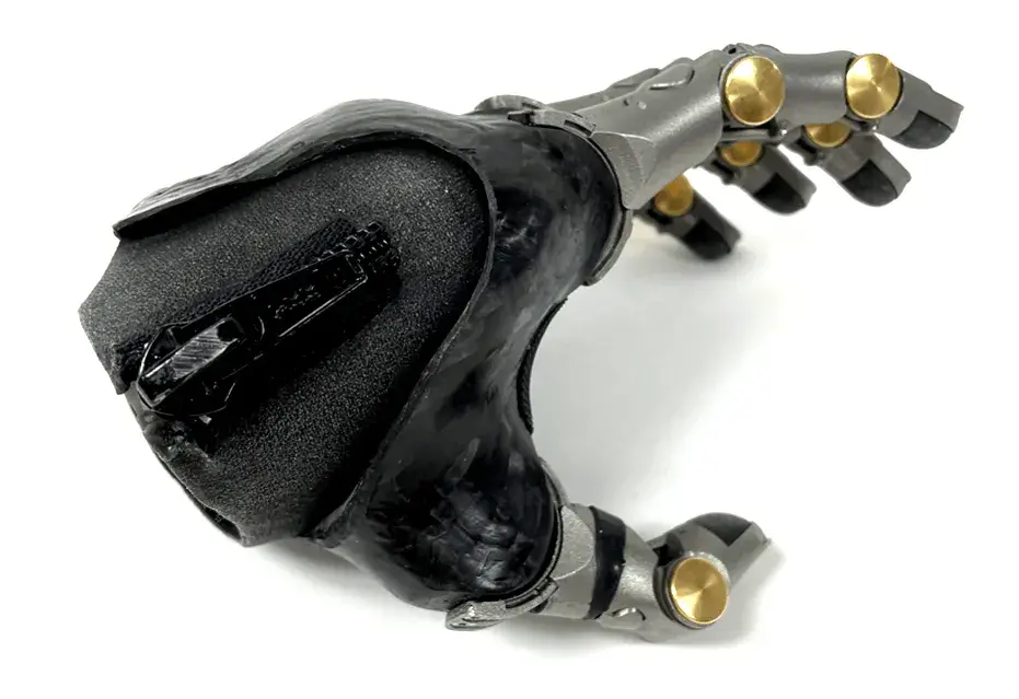 five finger socket prosthetic hand with metal 3D printed digits
