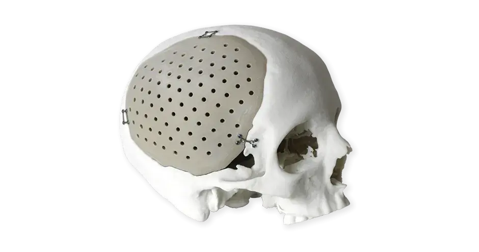 PEEK cranial implants