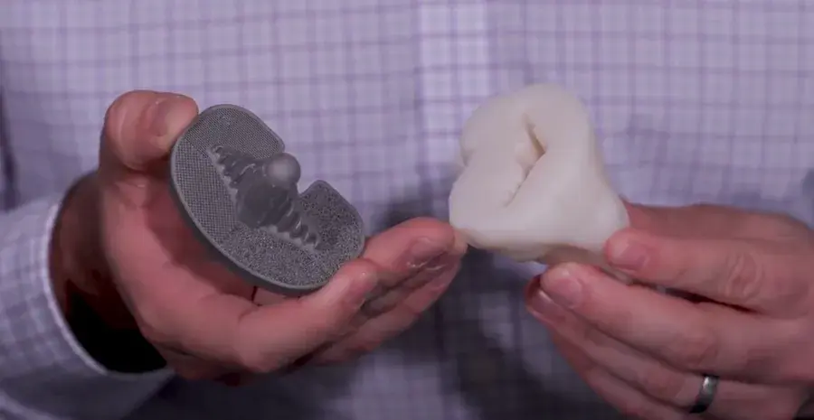 3D printed implants for total knee replacement