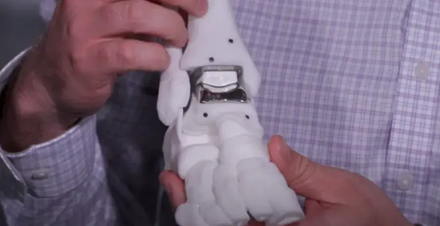 3D printed implants for total ankle replacement