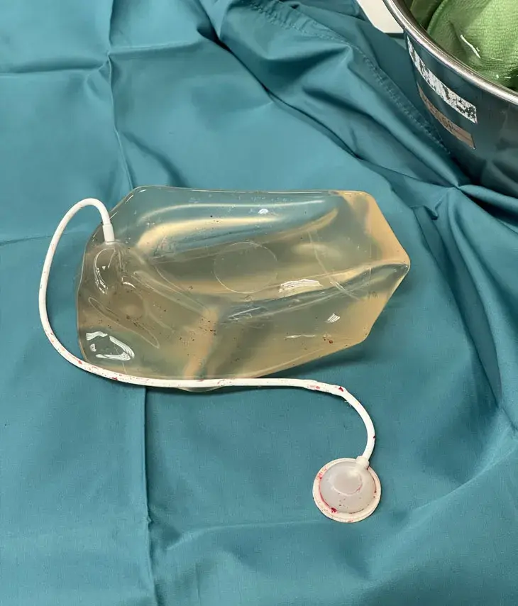 A 3D printed expander to widen the patient's scalp so that the implant fits properly underneath.