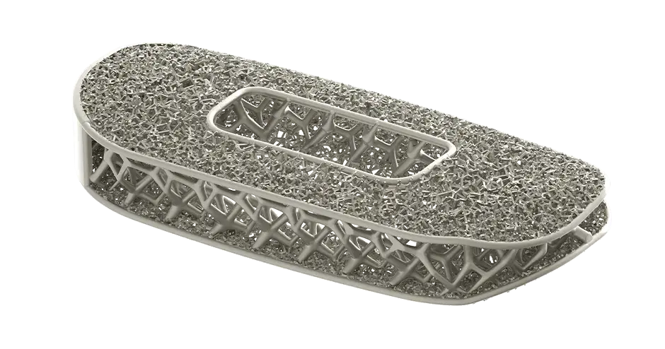 Optimized spinal implant by NuVasive produced using 3D printing