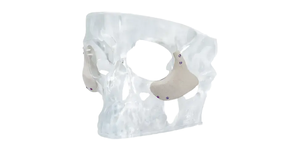 Facial Implants