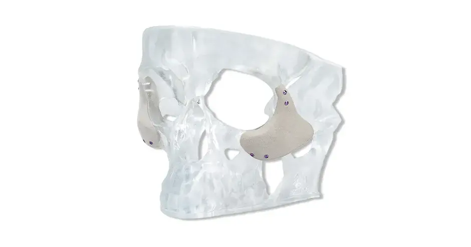 Point of care 3D printed implant