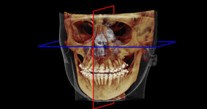 CMF CT Scan Image