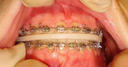 Intermediate splint in patient's mouth