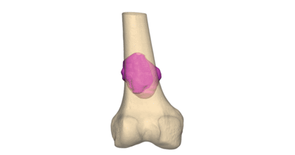 3d-systems-healthcare-vsp-orthopaedics-distal-femur-pre-op
