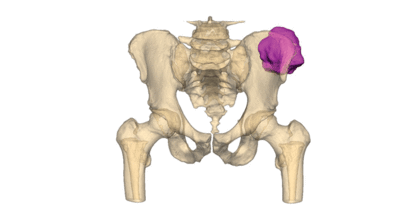 Web-Thumbnail-vsp-orthopaedics-pelvic-case-pre-op