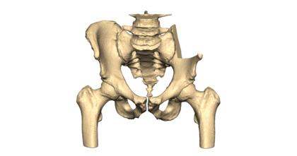 Web-Thumbnail-vsp-orthopaedics-pelvic-case-resection