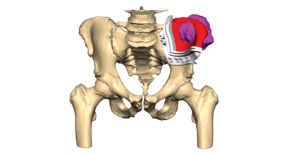 Web-Thumbnail-vsp-orthopaedics-pelvic-case-resection-instrument