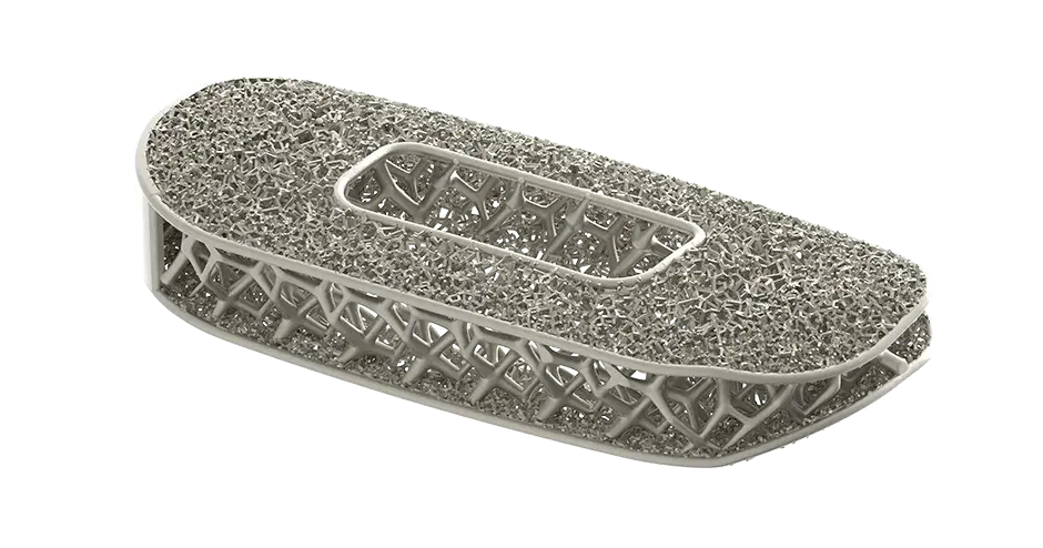 Optimized spinal implant by NuVasive produced using 3D printing 
