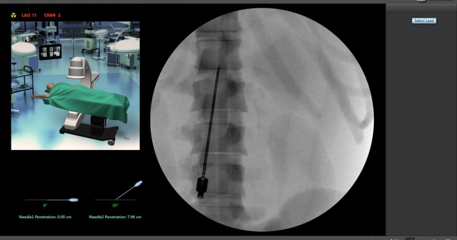 Spinal Cord Stimulation (SCS) | 3D Systems