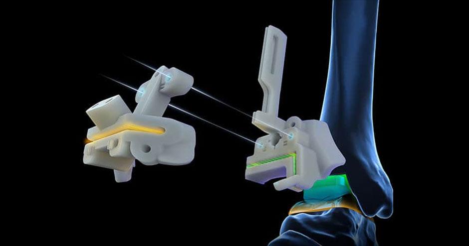 Personalized Ankle Surgery: Exactech’s Experience | 3D Systems