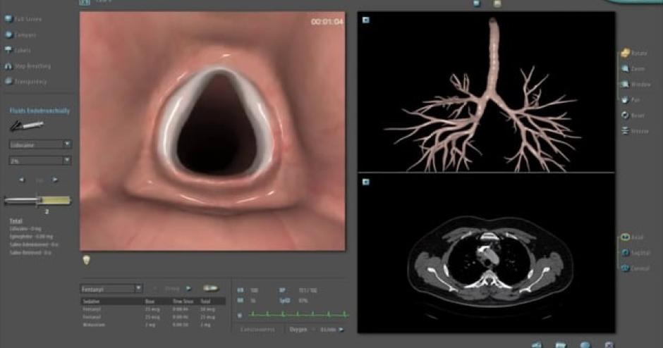 BRONCH Mentor - Diagnostic Bronchoscopy | 3D Systems